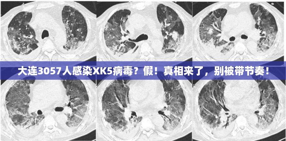 大连3057人感染XK5病毒？假