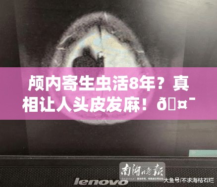 颅内寄生虫活8年？真相让人头皮发麻！🤯